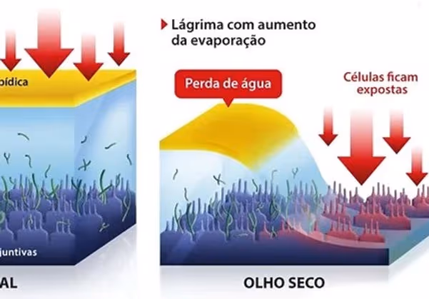 Foto mostrando como é a superfície ocular no olho seco.