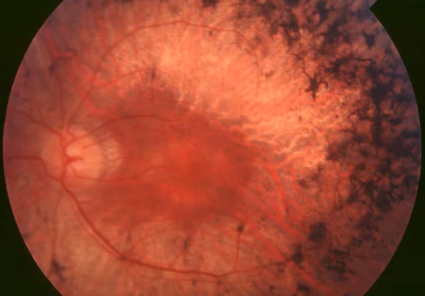 Foto de paciente com retinite pigmentar (retinose pigmentar).