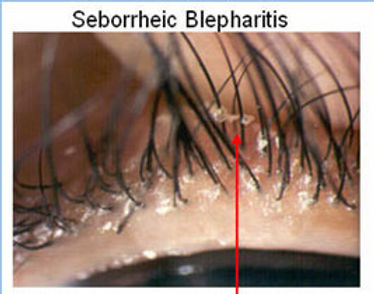 Blefarite seborreica com colaretes nos cílios.