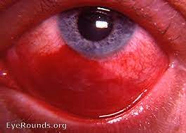 Conjuntivite Traumática: por lesão direta ao olho.