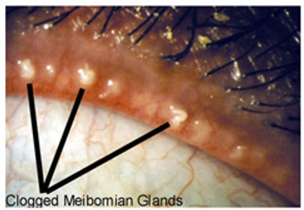 Orifícios entupidos das glândulas de meibômio ao lado dos cílios, com secreção purulenta.
