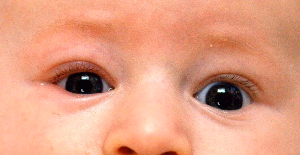 Bebê com blefarite da pálpebra inferior do olho direito.