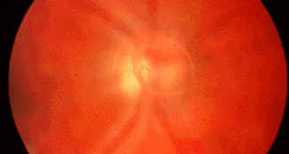 O descolamento do vítreo posterior é uma condição fisiológica que ocorre em pacientes com mais de 40-60 anos e pode estar associada ao descolamento de retina regmatogênico, ao aparecimento de moscas volantes e ao buraco de mácula.