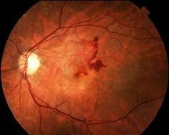 Pequenas Hemorragias que ocorrem na Retinopatia Diabética que podem levar à perda de visão.