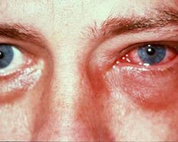 Conjuntivite Tóxica ou Conjuntivite Irritativa.