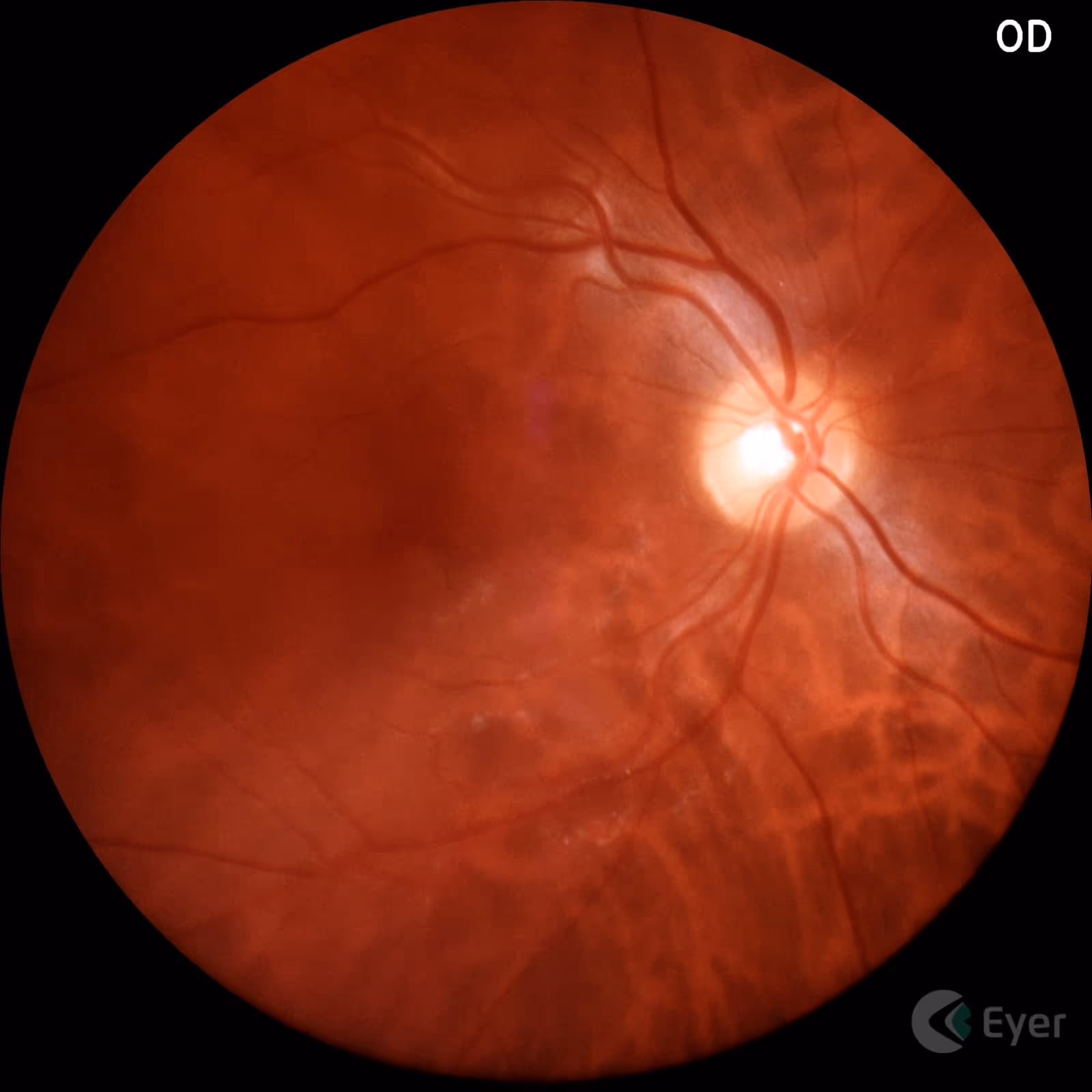 Imagem de retinografia normal