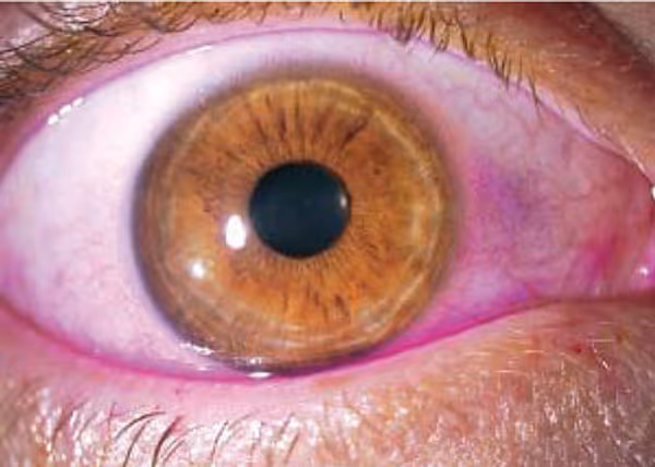 Teste com corante Rosa Bengala em paciente com olho seco.