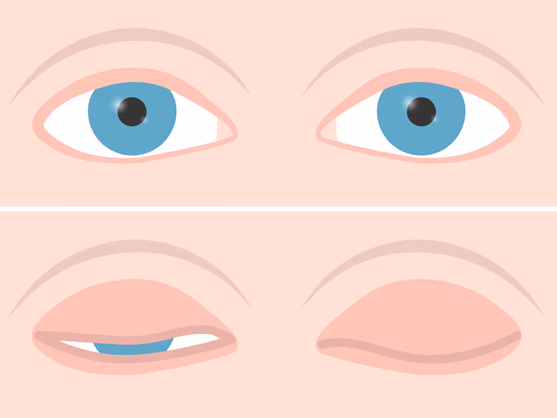 Lagoftalmo: quando o olho não fecha bem. Tem múltiplas causas conforme descrevo no texto acima.