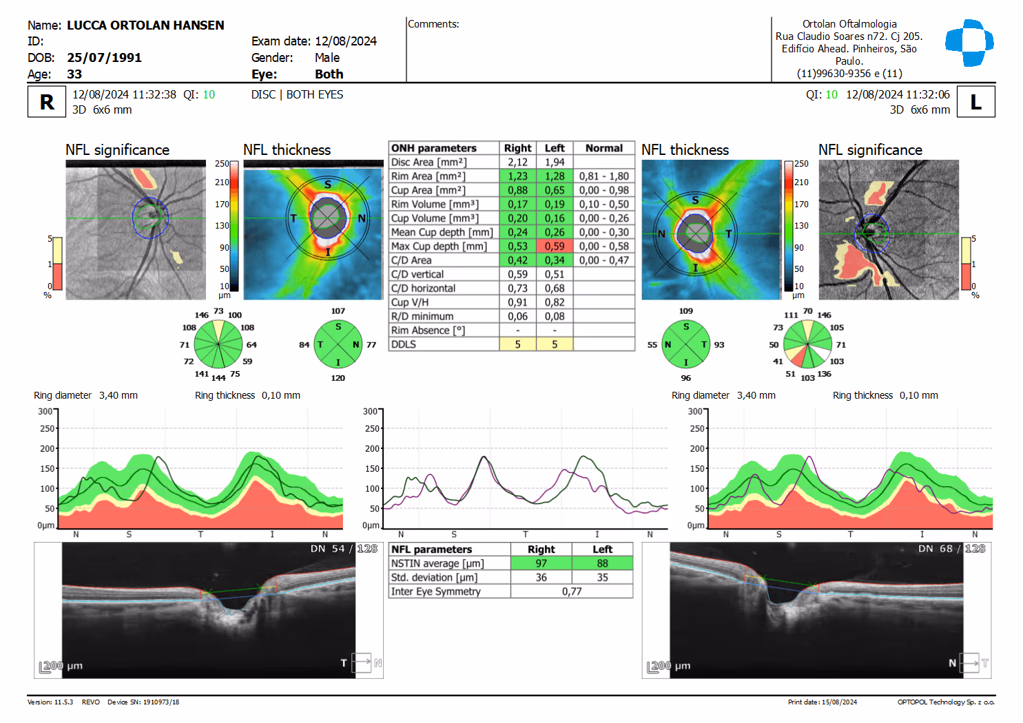 Avaliação da camada de fibras nervosas dos olhos, conforme análise estatística do OCT.
