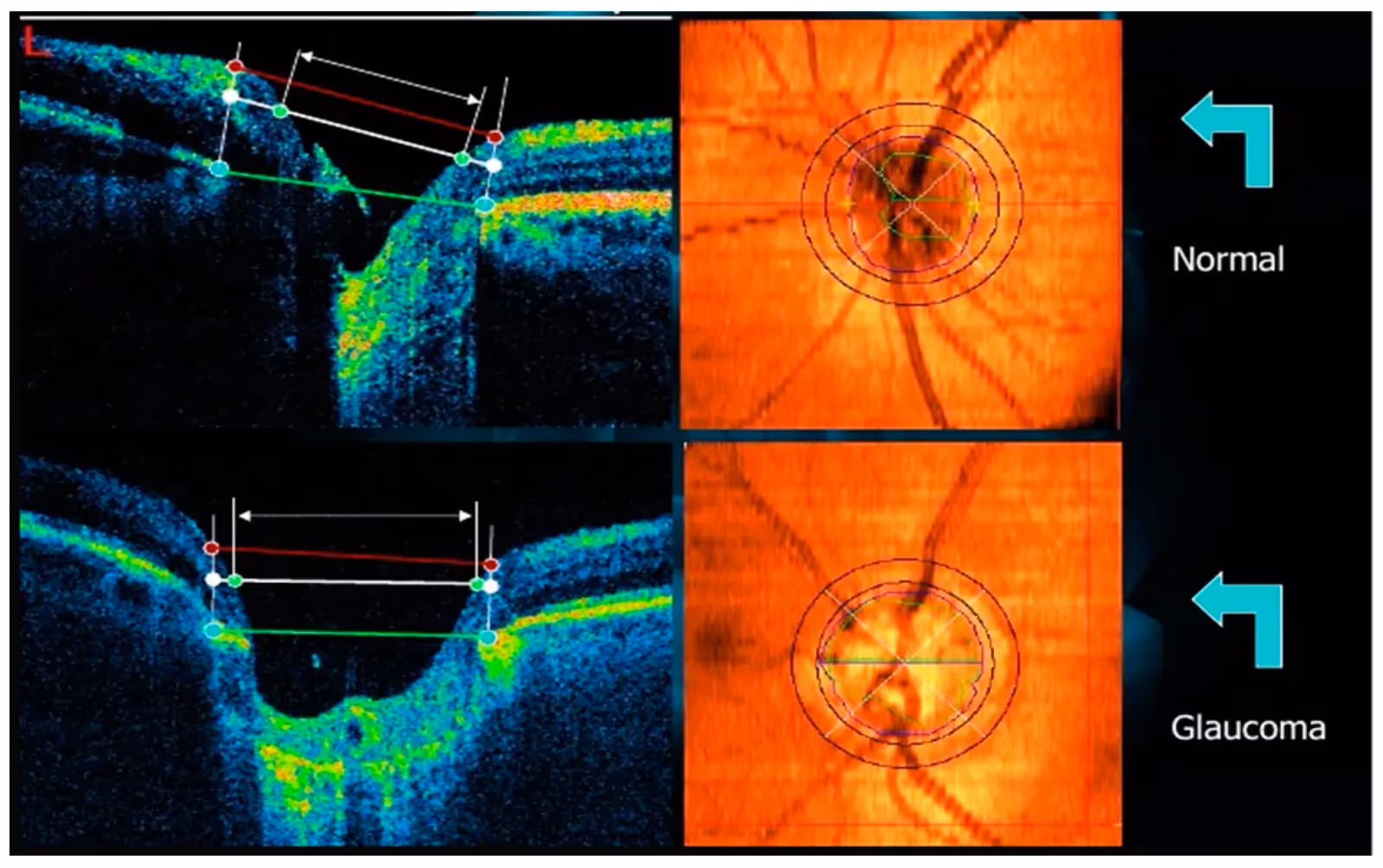 Imagem mostrando abaixo a alteração no exame de OCT ocasionada pelo glaucoma. Há aumento da escavação e perda da camada de fibras nervosas.
