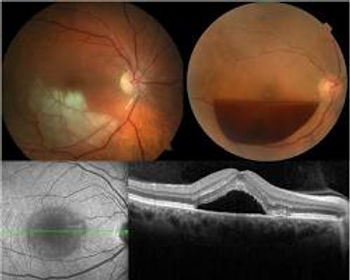 De cima para baixo e da esquerda para direita: oclusão de ramo de artéria central da retina, grande hemorragia pré-retiniana, retinografia mostrando coriorretinopatia central serosa, imagem de OCT mostrando coriorretinopatia central serosa.