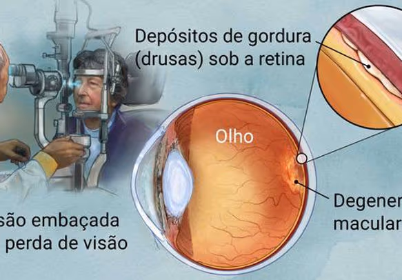 Imagem exemplificando os sinais e sintomas de Drusas com Degeneração Macular relacionada à idade. Mostra o depósito de gordura (drusas) sob a retina dos olhos do paciente. Esta doença causa perda de visão do centro da visão, pode causar visão embaçada ou perda de visão central com mancha (escotoma). Ao lado mostra um desenho esquemático do olho humano mostrando onde é a alteração da DMRI (entre a coroide e a retina).