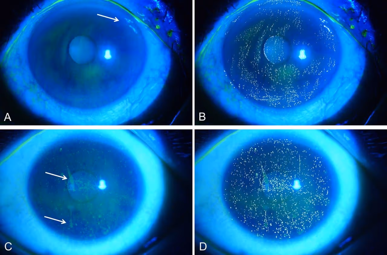 Teste com fluoresceína na córnea.