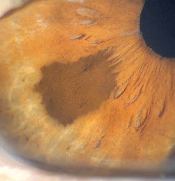 Imagem mostrando sinal (pinta ou mancha) na íris do olho. Usada como introdução no tema de nevus de íris, nevus de coróide e nevus de pele. Fala-se no artigo sobre a distinção entre os nevus, nevii e melanoma. Melanoma de pele, melanoma de íris ou melanoma de coroide.