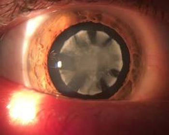 Catarata traumática.