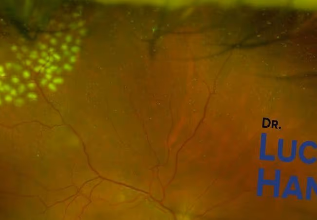 Imagem mostrando caso de descolamento de retina com rasgo em ferradura (horseshoe tear) tratado com fotocoagulação pelo dr. Lucca Ortolan Hansen da Ortolan Oftalmologia.