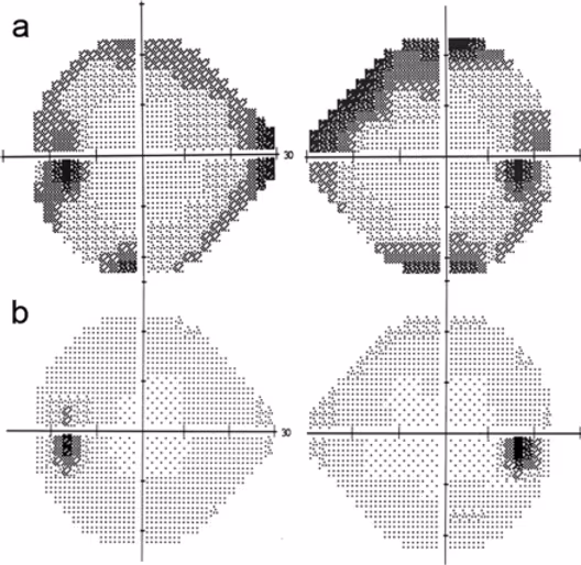 Campimetria 24-2 de paciente com glaucoma (A) e paciente normal (B). Note a perda visual periférica causada pelo glaucoma (área escura no gráfico).