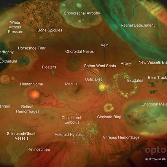 Oclusões vasculares da retina