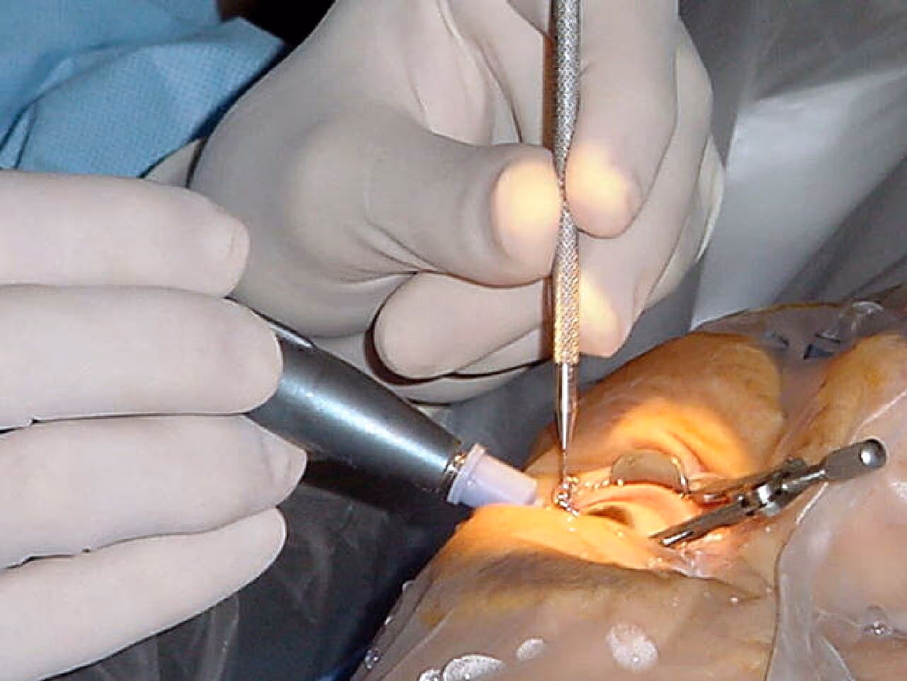 Paciente em equipamento de exame oftalmológico, semelhante ao usado para aplicar a capsulotomia com laser YAG. Paciente em equipamento de exame oftalmológico, semelhante ao usado para aplicar a capsulotomia com laser YAG.