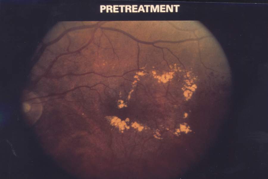 Retinopatia diabética com edema macular.