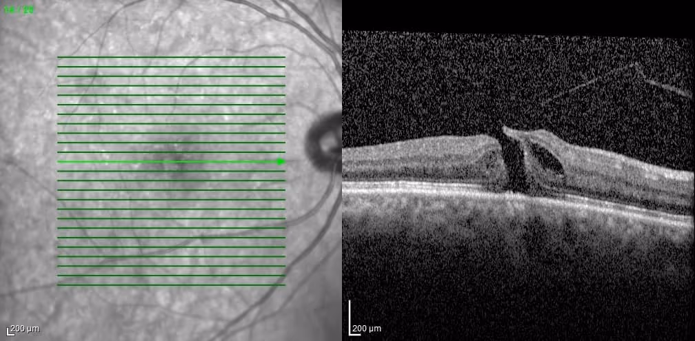 Tomografia de coerência óptica mostrando buraco de mácula.