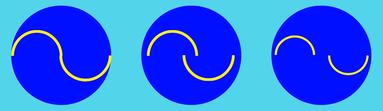 Medida da pressão intraocular no acompanhamento após o SLT.