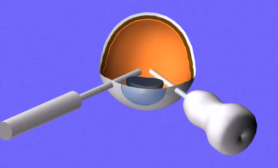 Instrumentação de vitrectomia 23G usada em descolamentos de retina.