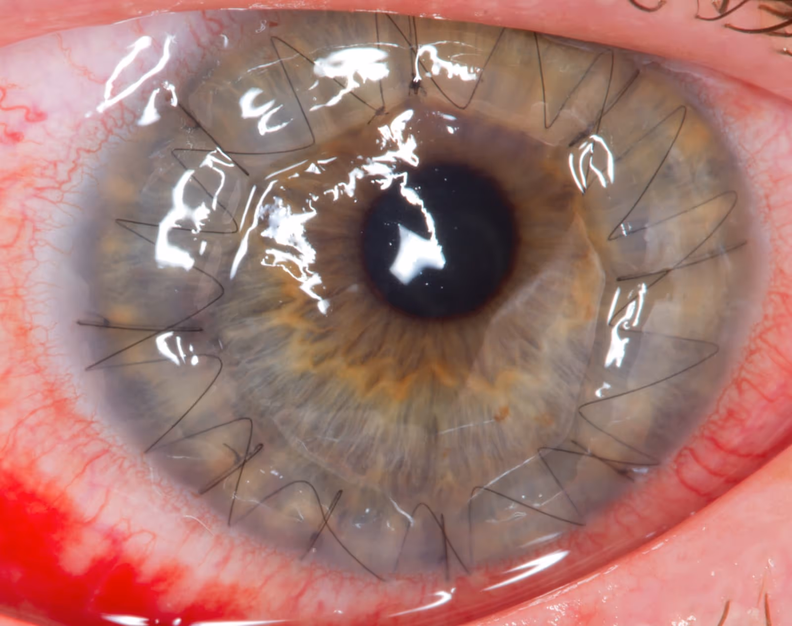Cirurgia de transplante de córnea